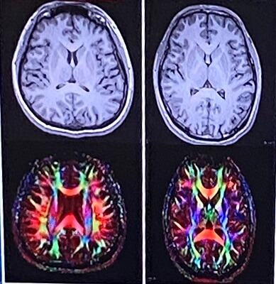 他人の脳のMRIと神経のつながり方