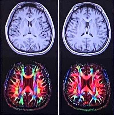 一卵性双生児の脳のMRIと神経のつながり方
